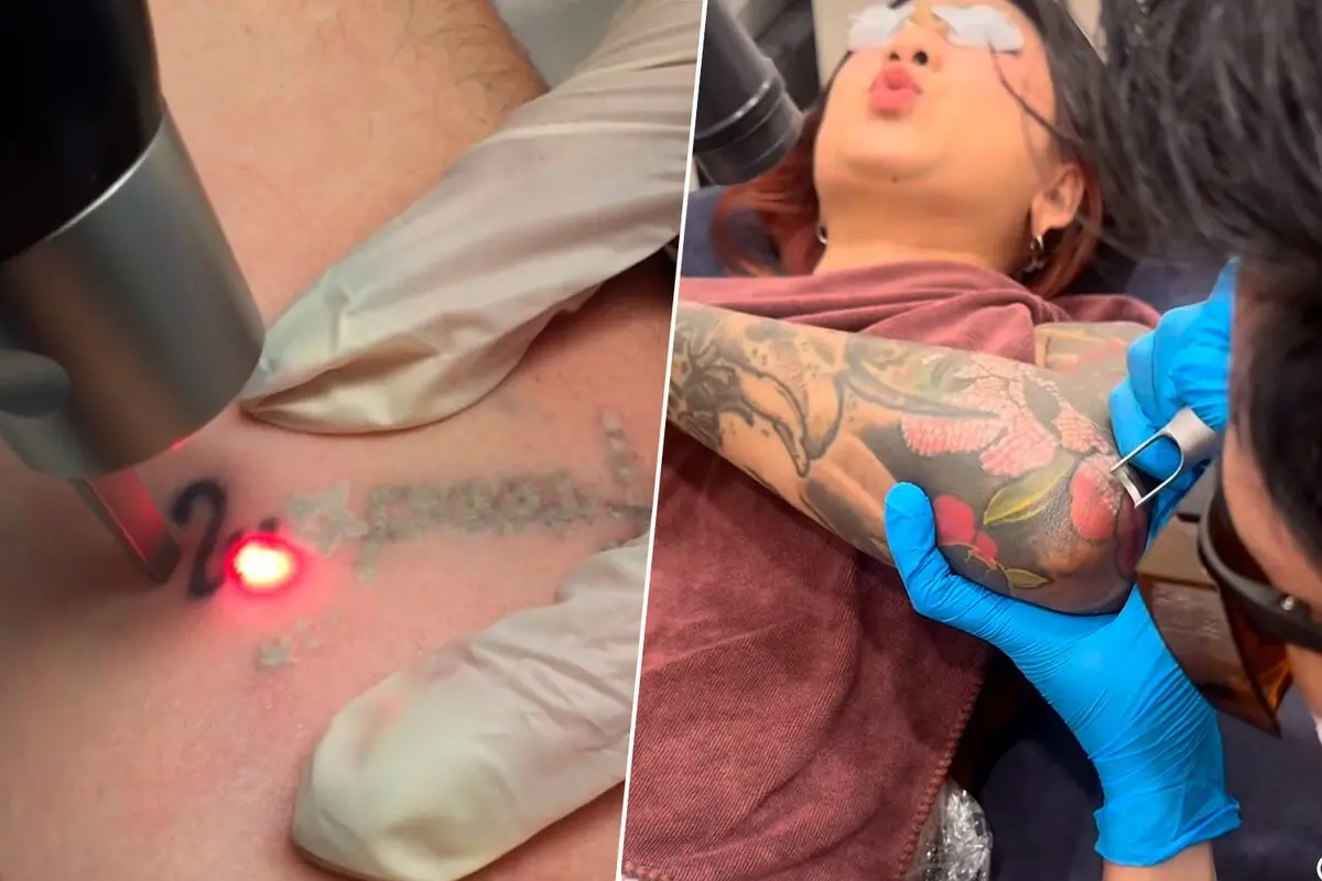 ¡Descubre por qué los jóvenes españoles están eliminando sus tatuajes a gran velocidad!